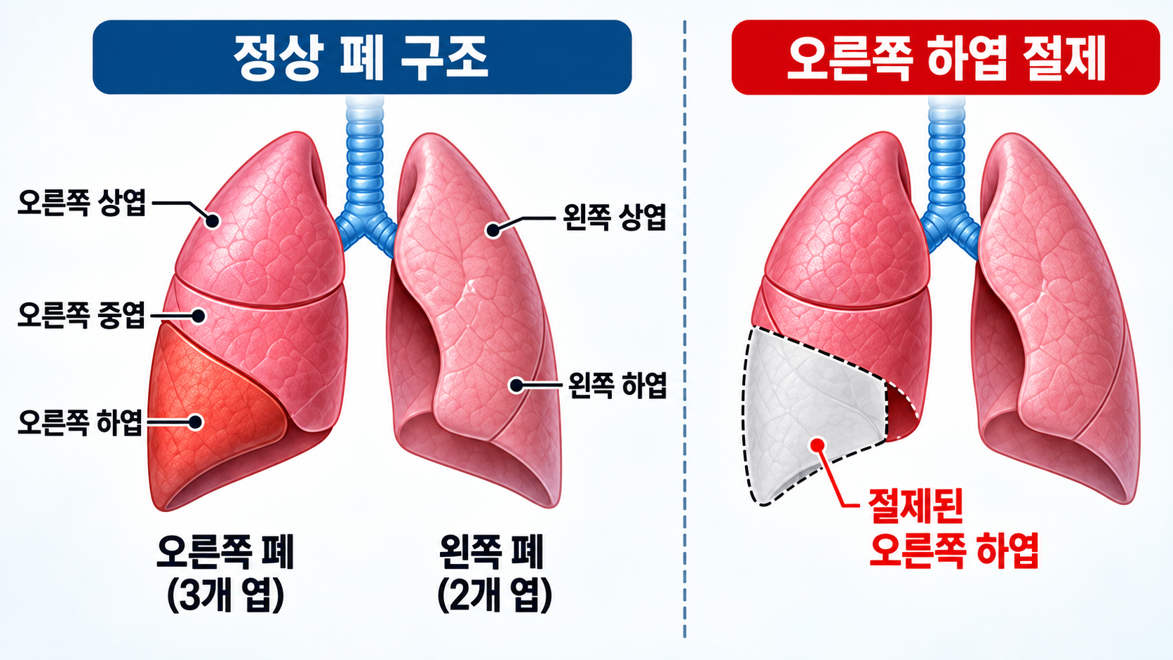 오른쪽 폐의 상엽 중엽 하엽과 왼쪽 폐의 상엽 하엽을 구분하고 오른쪽 하엽 절제 위치를 표시한 인체 해부학 인포그래픽