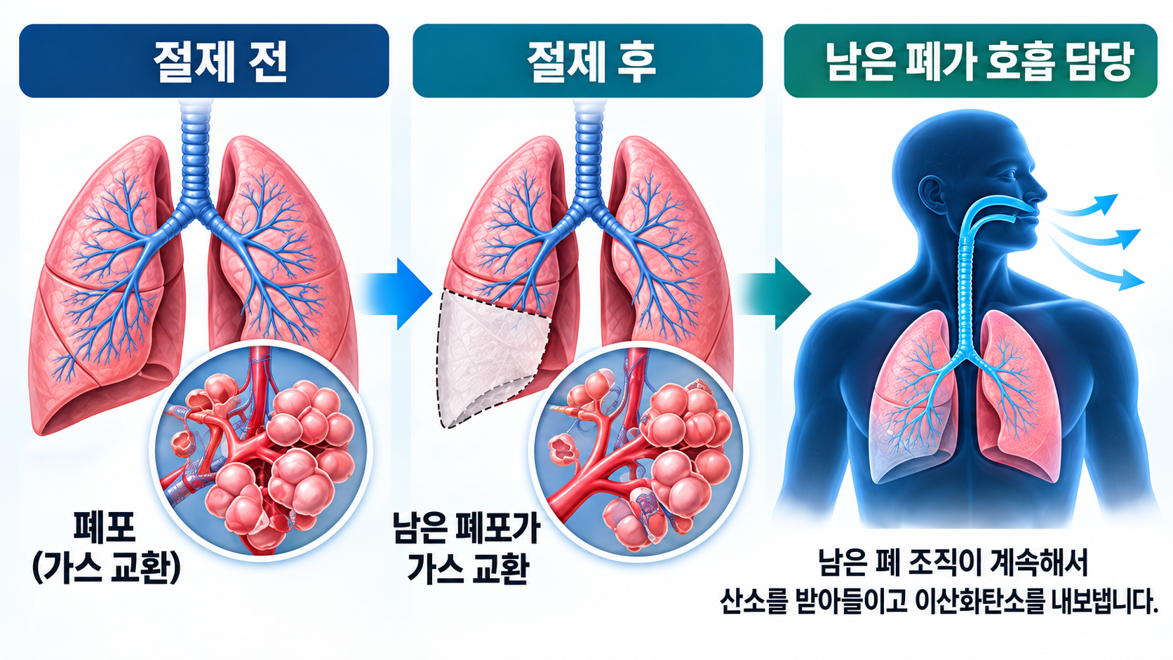 정상 폐와 폐엽 절제 후 남은 폐의 호흡 기능을 비교하고 산소 교환이 계속 이루어지는 원리를 보여주는 의료 인포그래픽